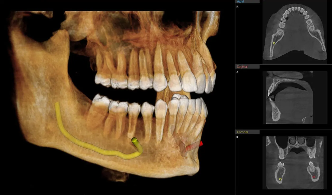 3D CBCT (Cone Beam Computed Tomography)