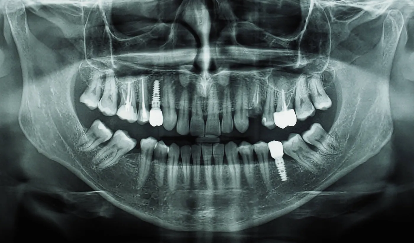 Ortopan (ortopantomogram)